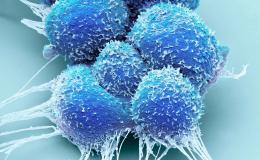 Prostate cancer cells