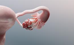 3d representation of ovarian cancer
