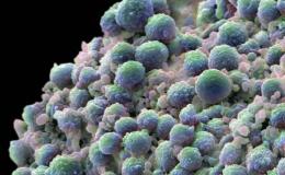 Prostate cancer cells.jpg