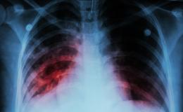 TB lung scan.jpeg