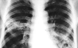 lungs xray 1.jpg