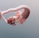 3d representation of ovarian cancer