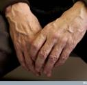 Parkinson's elderly hands_2.jpg